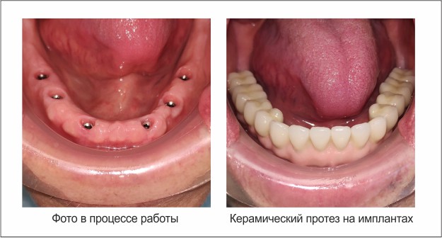 импланты до послпе.jpg импланты до послпе.jpg