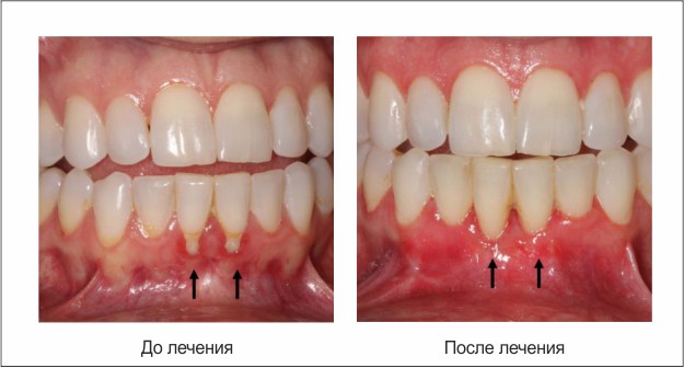 Лечение десен